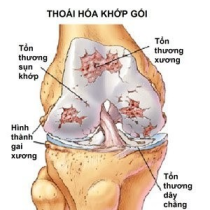Viêm đau cơ khớp gối: Triệu chứng, nguyên nhân và cách điều trị tại Phòng Khám Bác Sĩ Thone