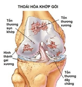 THOÁI HÓA KHỚP