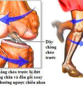 ĐỐT DÂY CHẰNG