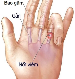 VIÊM GÂN - TÊ TAY 