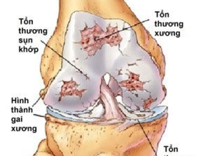 Viêm đau cơ khớp gối: Triệu chứng, nguyên nhân và cách điều trị tại Phòng Khám Bác Sĩ Thone